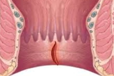 Bleeding Per Anus And Only Free Treatment (2)
