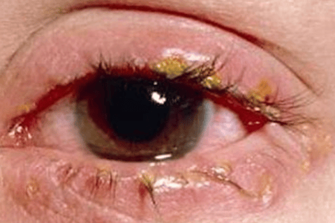bepharitis