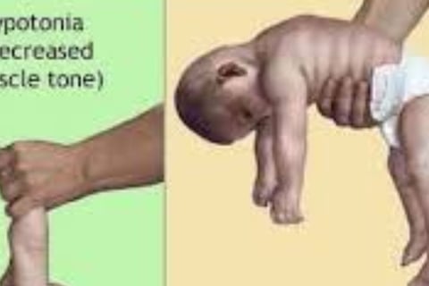 hypotonia