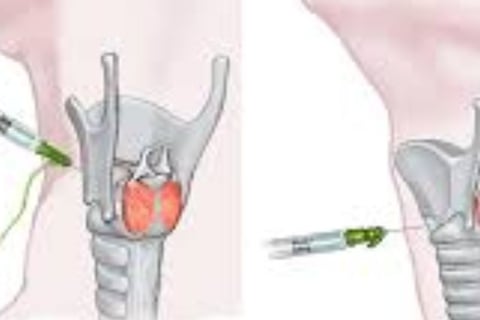 injection for laryngeal spasm