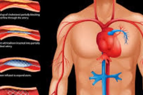 Cardiac Catheterization