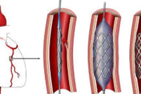 Cardiac Catheterization: Why Every Case Is Followed by a Stent