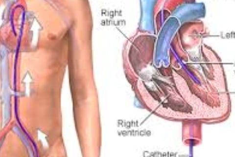 Cardiac Catheterization: Why Every Case Is Followed by a Stent