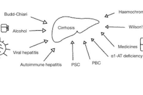 causes and symptoms liver cirhosis