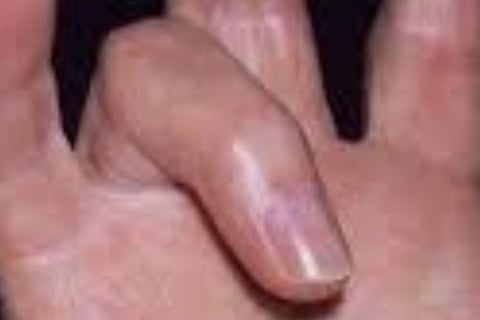 🤲 Trigger Finger & the Role of Voluntary Fasting: A Natural Healing Approach