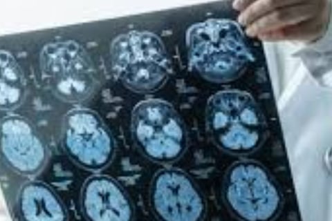 علاج السكتة الدماغية الإقفارية والنزيفية والنوبات الإقفارية العابرة