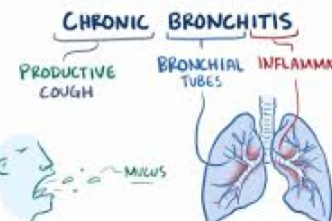 Bronchitis