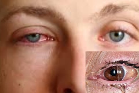 Conjunctivitis