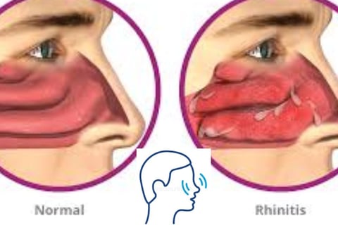 Dr. Hassan Al Warraqi's Approach to Disease Treatments Rhinitis (Inflammation of the Nasal Mucous Me