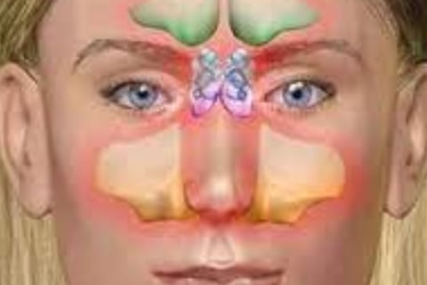 Dr. Hassan Al Warraqi's Approach to Disease Treatments Sinusitis