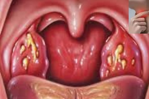 Tonsillitis