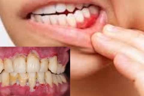 Gingivitis