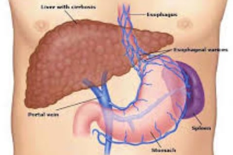 Esophageal Varices