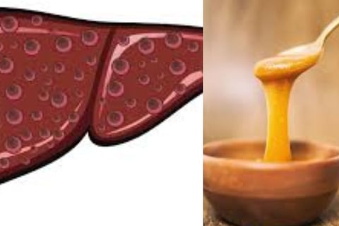 Esophageal Varices honey manouka and fasting