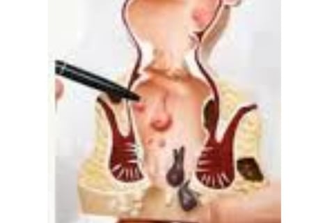 FAQs : Natural Remedies for Anal Fissures and Fistulas: Start with Honey and Fasting