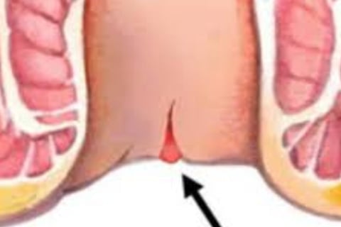 FAQs : Natural Remedies for Anal Fissures and Fistulas: Start with Honey and Fasting
