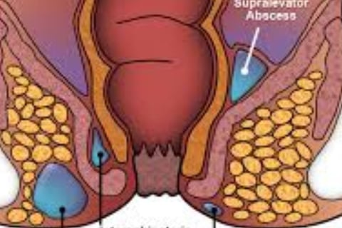 FAQs Natural Remedies for Anal Fissures and Fistulas Start with Honey and Fasting