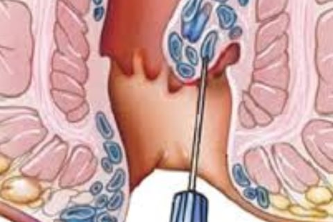 FAQs Natural Remedies for Anal Fissures and Fistulas Start with Honey and Fasting