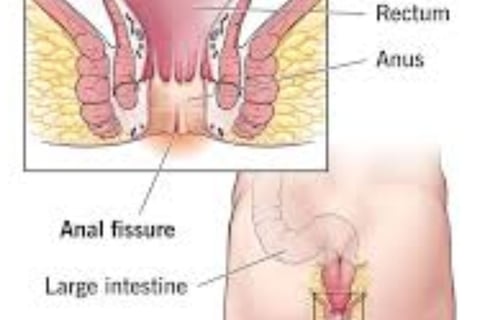 FAQs : Natural Remedies for Anal Fissures and Fistulas: Start with Honey and Fasting
