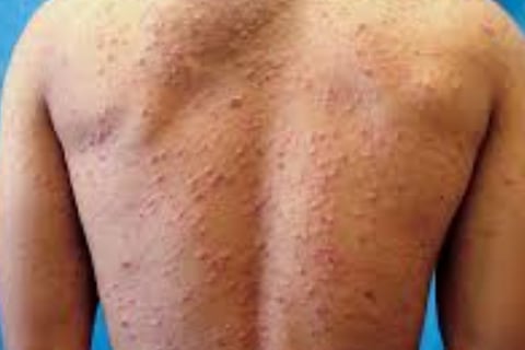 Fasting For Skin Allergies Itching & Pruritus