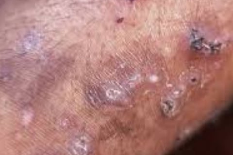 Fasting for Skin Allergies, Itching, and Pruritus