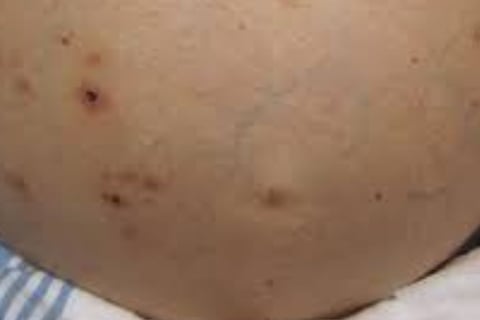 Fasting for Skin Allergies, Itching, and Pruritus