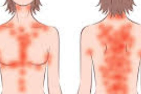 Fasting For Skin Allergies Itching & Pruritus