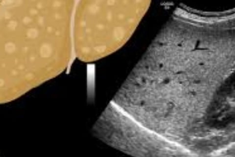 fatty liver ultrasonography