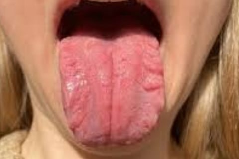  FISSURED TONGUE