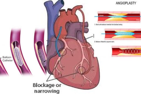 Cardiac Catheterization: Why Every Case Is Followed by a Stent