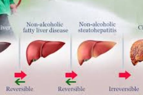 Fatty Liver Disease irreversable cirrosis