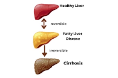 stages of fatty liver diseases