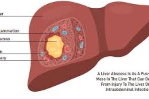 Multiple Body Abscesses Fasting and Honey (4)