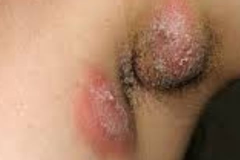 Multiple Body Abscesses
