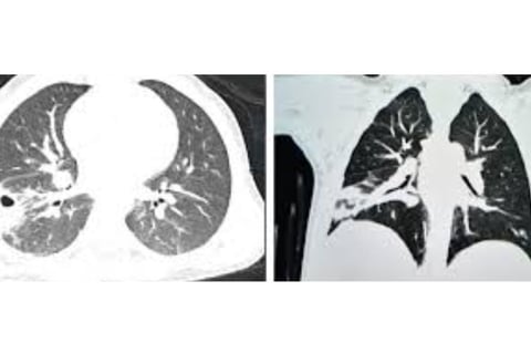 Multiple Body Abscesses Fasting and Honey (6)