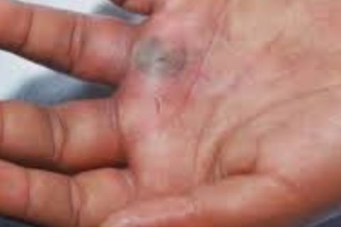 Multiple Body Abscesses