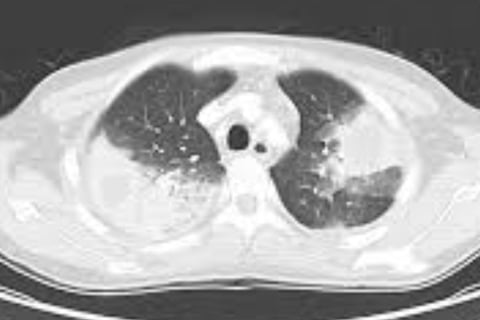 Multiple Body Abscesses Fasting and Honey (8)