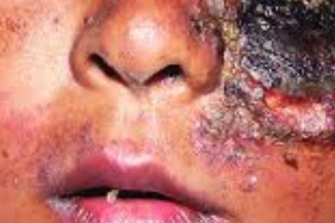 Necrotizing fasciitis Flesh-eating ocular disease