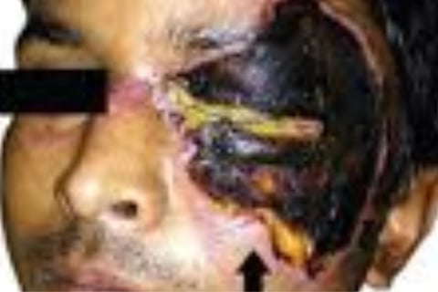 Necrotizing fasciitis Flesh-eating ocular disease