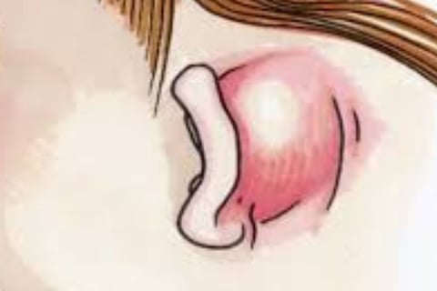 mastoiditis
