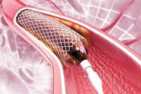 Cardiac Catheterization: Why Every Case Is Followed by a Stent