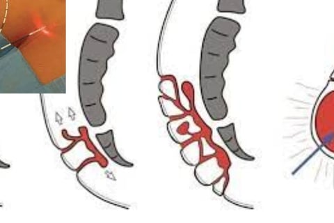 Home treatment of fistula My experience in treating fissures