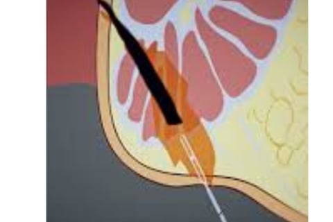 Anal fissures and fistulas: Treatment without surgery