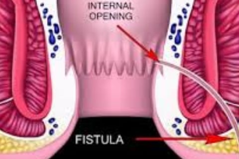 Water fasting or intermittent fasting may allow the digestive system to rest, reducing irritation in