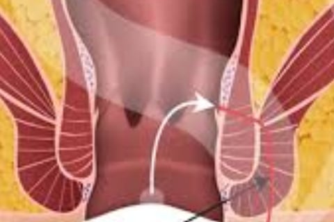 Water fasting or intermittent fasting may allow the digestive system to rest, reducing irritation in