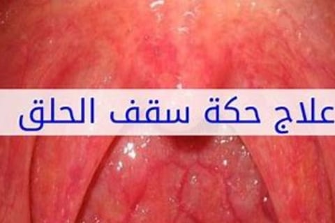 حكة بالحلق