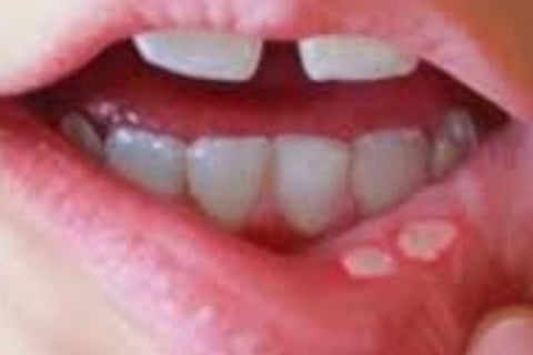 القرحة