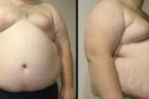 متلازمة التمثيل الغذائى   