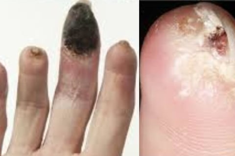 Painful Digital Ulcers : role of Role of Fasting and Cold Water