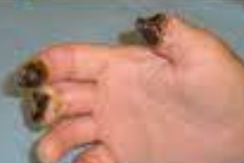 Painful Digital Ulcers : role of Role of Fasting and Cold Water